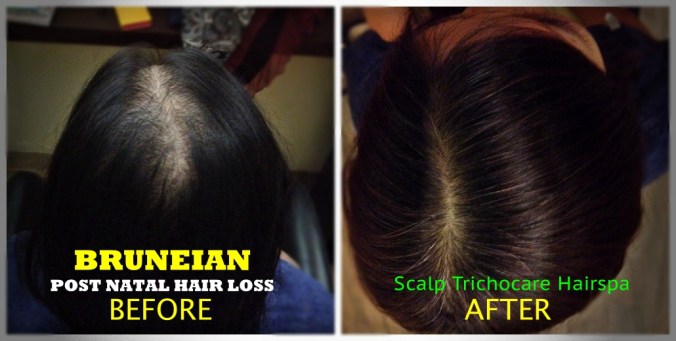 2.0 WEB Post Natal Hair Loss Before vs After